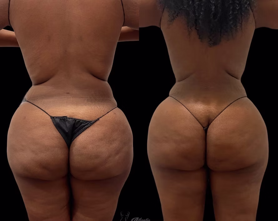 Before and after Lipo 360, back view showing a slimmer waist, flanks, and back