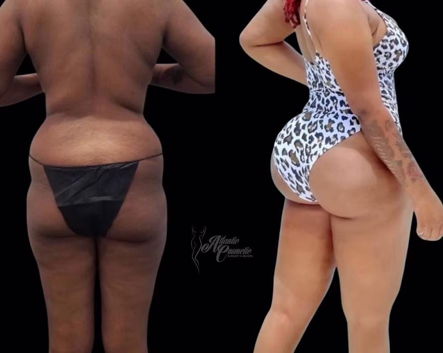 Before and after Lipo 360 with BBL, back view showing a narrower waist and fuller, rounder shape