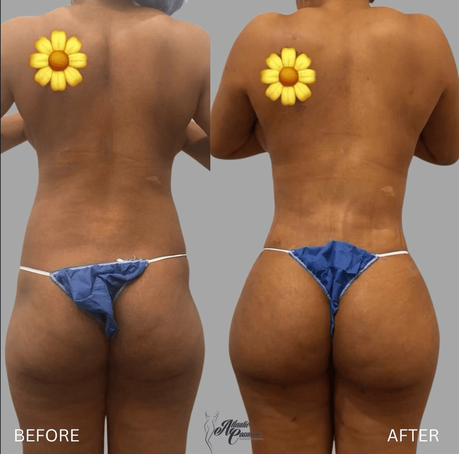 Before and after BBL, back view showing improved shape and projection