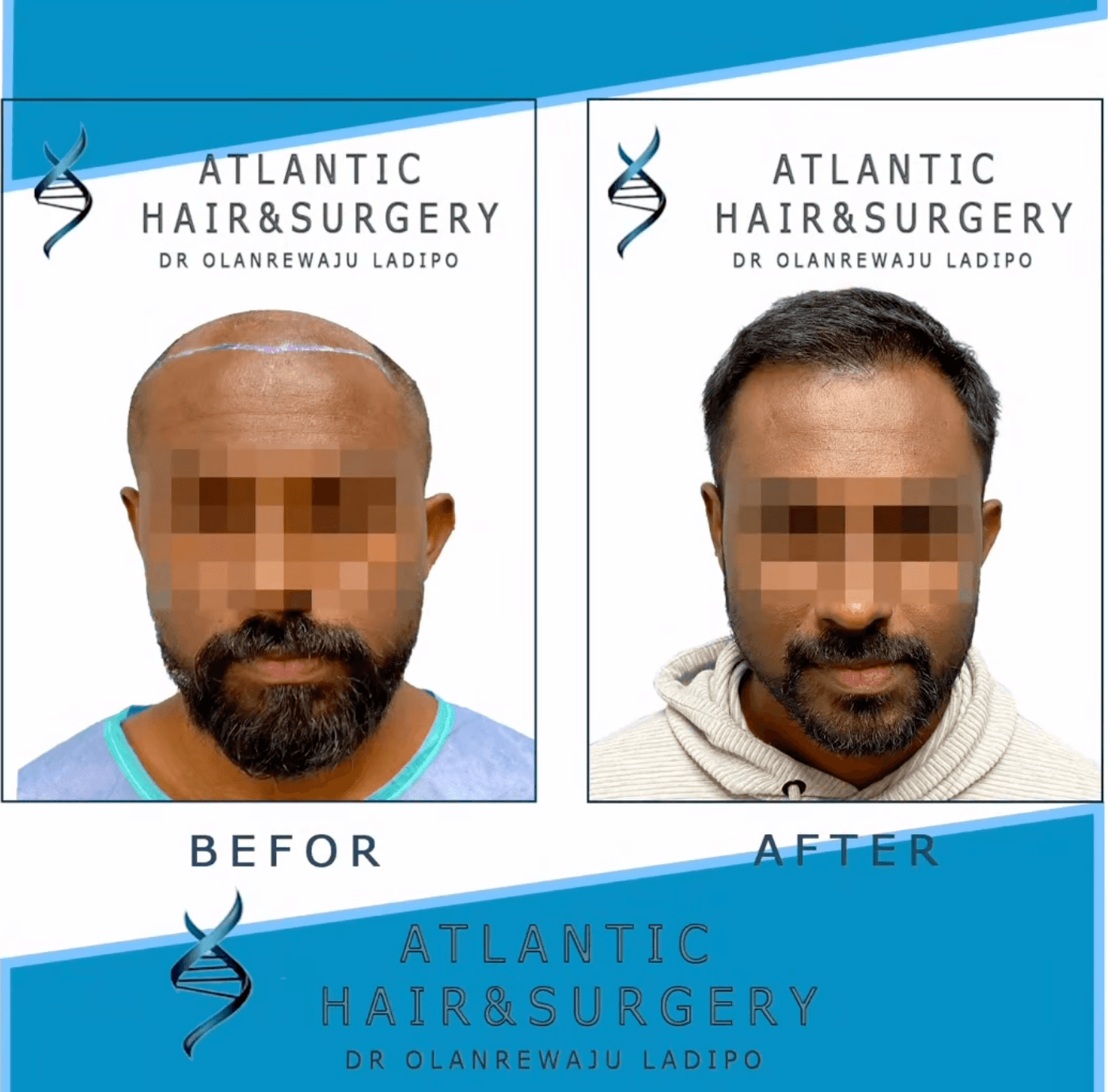 Before and after FUE hair transplant, front view showing restored hairline