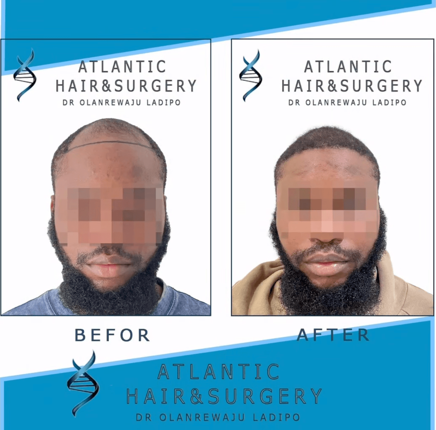 Before and after FUE hair transplant, front view of the hairline and temples