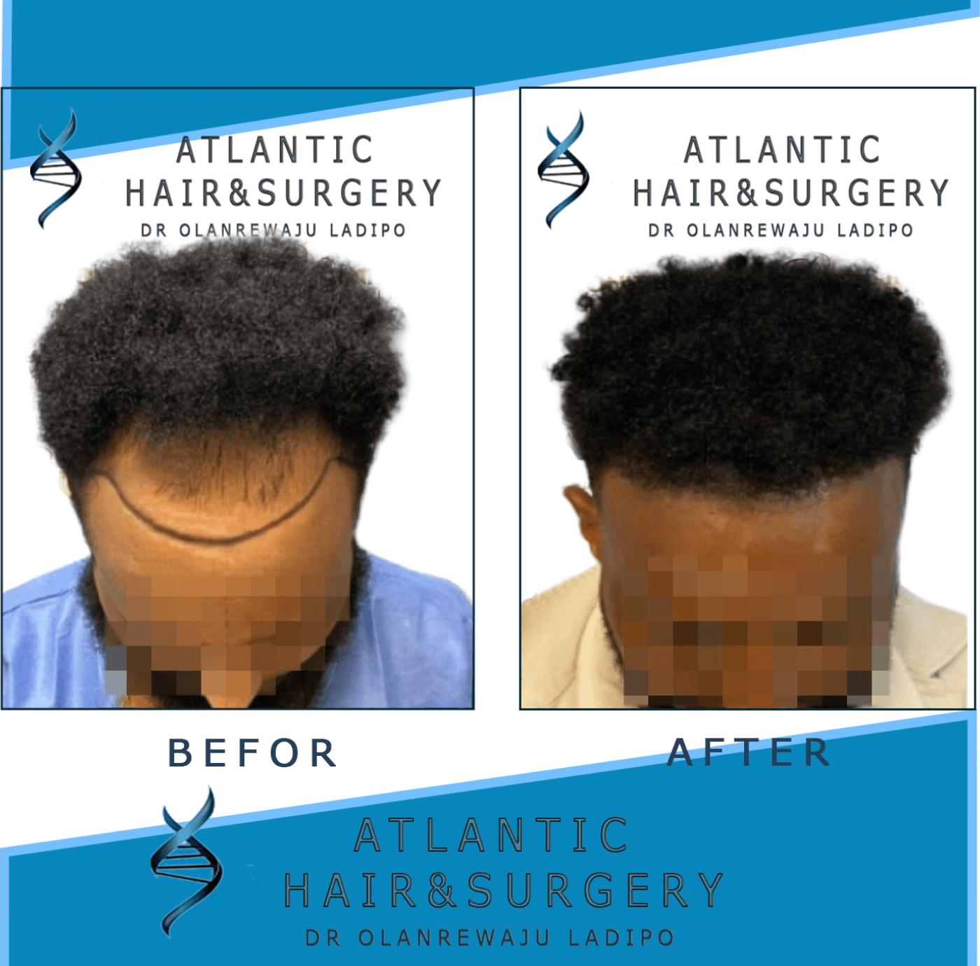 Before and after FUE hair transplant, top view of the crown and hairline