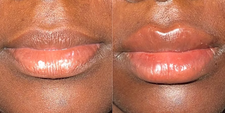 Before and after lip filler, close-up showing fuller, smoother lips