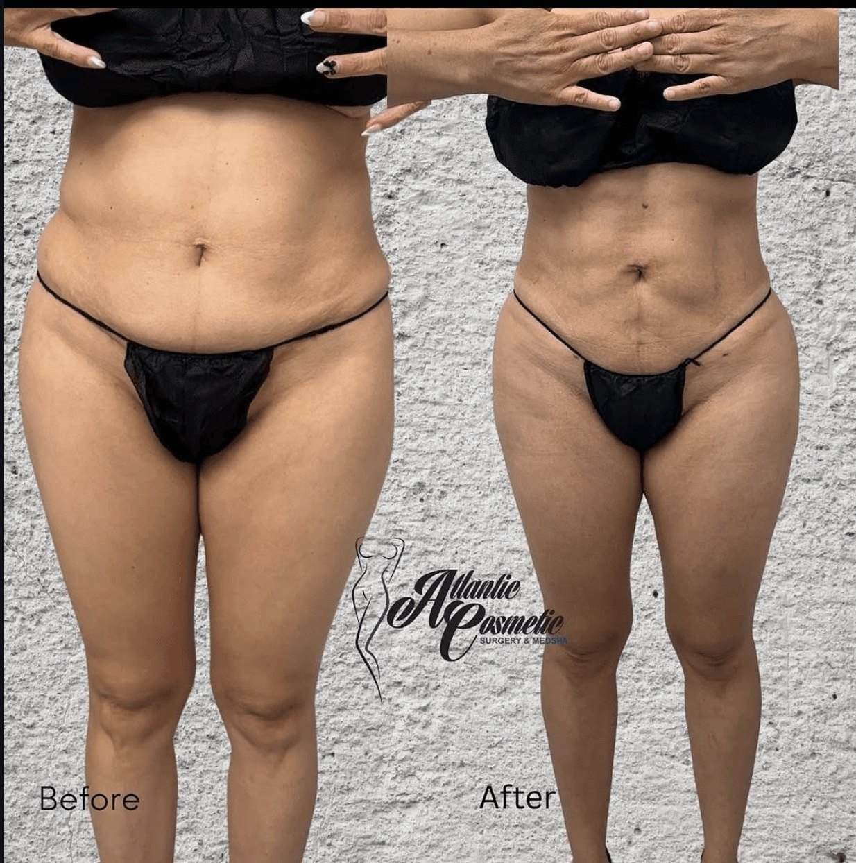 Before and after Lipo 360, front view of the abdomen and waist