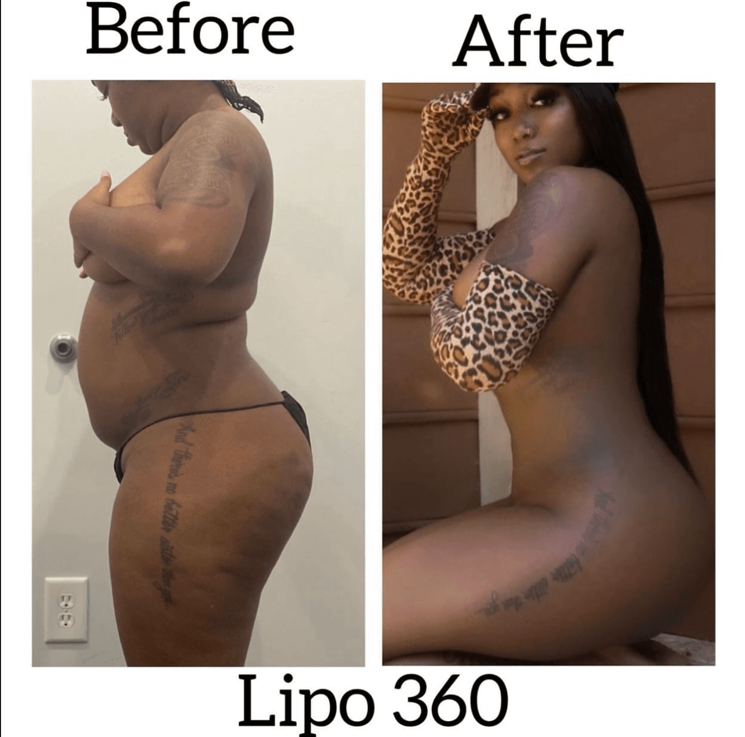 Before and after Lipo 360, side profile