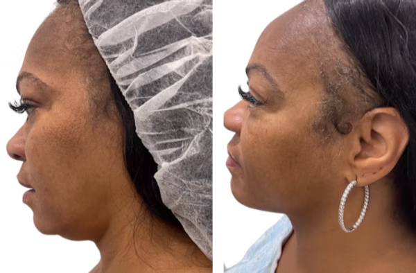 Before and after neck and jawline contouring, side profile showing a more defined jawline